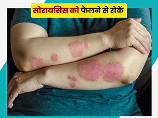 शरीर में सोरायसिस (Psoriasis) इंफेक्शन होने पर इसे फैलने से कैसे रोकें? एक्सपर्ट से जानें लक्षण और बचाव 
